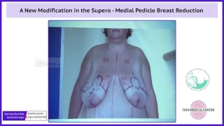 01 A New Modification in the Supero   Medial Pedicle Breast Reduction