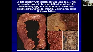 Inflammatory Bowel Disease  -Dr  A  Manoharan