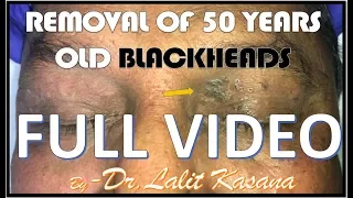REMOVAL OF 50 YEARS OLD BLACKHEADS FULL VIDEO by DR.LALIT KASANA