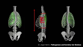 3D-Modell: Pathogenese und Korrektur der Skoliose (Prof. Harms)