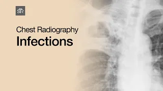 Chest Radiography: Infections