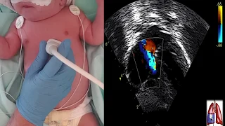 ECHOCARDIOGRAPHIC ASSESSMENT OF PULMONARY ARTERIAL HYPERTENSION IN THE NEWBORN