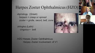 Herpes Zoster Ophthalmicus