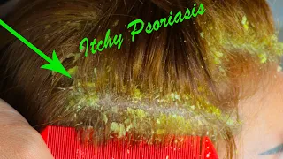 Dandruff Removal With Comb Satisfying - Big Flakes Scalp Scratching And Picking #251
