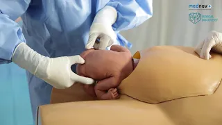 Caesarean Section for Breech Presentation