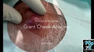 Large cheek abscess. Inflamed cyst pop and drainage. I+D. Dermatology procedure. MrPopZit