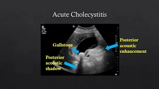 Abdominal US - Gallstones/Cholecystitis, Renal Stones/Hydronephrosis