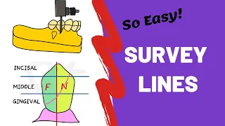 Survey lines in Prosthodontics | FREE NOTES