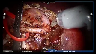 Robotic spleen-preserving distal pancreatectomy for solid pseudopapillary neoplasm,