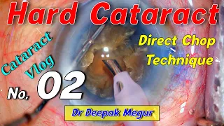 Phaco in a Hard Brown Cataract Cataract  (Vlog 2, Direct chop technique)-Dr Deepak Megur