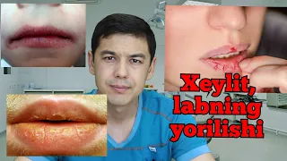 XEYLIT, LAB YORILISHI DAVOSI. ХЕЙЛИТ, ЛАБ ЁРИЛИШИ ДАВОСИ.