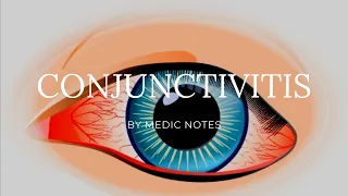 Conjunctivitis - bacterial vs viral, clinical features, treatment, conjunctival papillae vs follicle