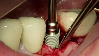 Dentium bone level implant system (SuperLine)