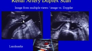Renal Artery Duplex Scan