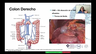 Resección D2 vs D3 en Hemicolectomía Derecha