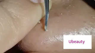 No squeezing whiteheads removal (Facial 28)