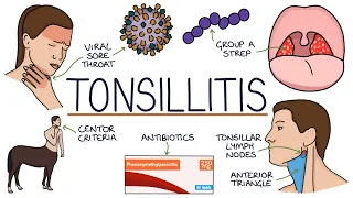 Understanding Tonsillitis