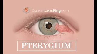 Pterygium Eye (Surfer's Eye) Treatment, Causes and Symptoms
