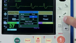 X Series®: Pacing (English)