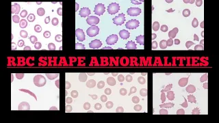 RBC Shape Abnormalities In Peripheral 🩸Blood Smear | Made Easy | Images