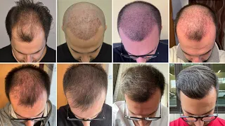 Das WACHSTUM nach einer Haartransplantation [Zeitraffer 0 - 12 Monate]