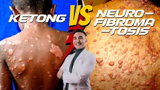 5 Signs ng Ketong (Leprosy) vs Neurofibromatosis #kilimanguru