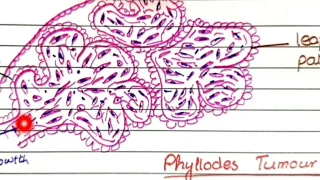 Fibroadenoma And Phyllodes Tumor | Pathology