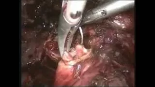 Laparoscopic Choledochoduodenostomy 18 (Prolonged CBD stent, Recurrent stones, Distal CBD stenosis)