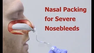 Nasal Packing for Severe Nosebleeds