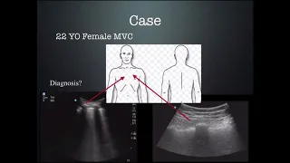 Thoracic Ultrasound Part 4 CUSE 2018