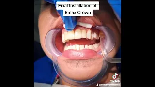 Final Installation of E-max porcelain crown.