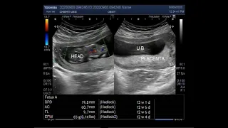 Ultrasound Video showing Placenta Previa.