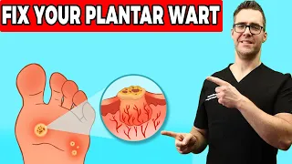 Plantar Warts Removal at Home Treatment  [Foot & Toe Wart Remedies]