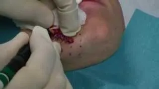 W-Plasty to scar on the chin