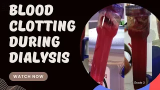 What are the Causes of blood clotting during dialysis | clotting of blood in dialysis
