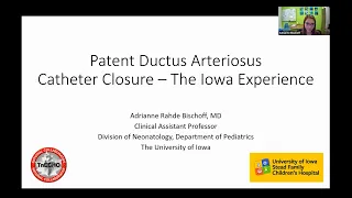 Patent Ductus Arteriosus Catheter Closure - The Iowa Experience