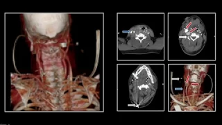 Neck Trauma | Interesting Radiology Cases