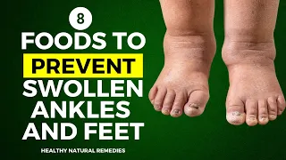 8 Amazing Foods To Prevent Swollen Ankles And Feet