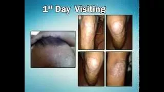 Psoriasis Treatment before and after by Dr Chaithanya KS