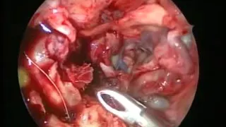 Anterior skull base dissection Video 3 - cadaver 2 - by Dr.Satish Jain