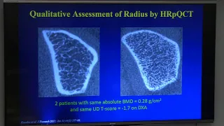 Primary Hyperparathyroidism - Dr. Shonni J  Silverberg