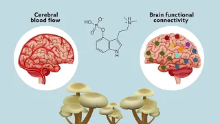 Psilocybin may ‘reset’ the brain to help manage treatment-resistant depression