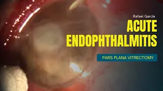 Acute Endophthalmitis