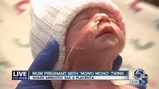 RARE: Mono Mono Twins Born Holding Hands