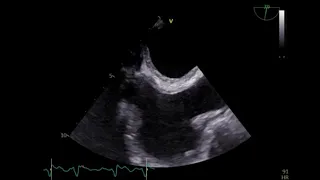 Isolated atrial #amyloidosis (IAA) a diagnostic & therapeutic challenge