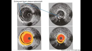 Intravascular ultrasound (IVUS) - Elias Hanna, Univ of Iowa