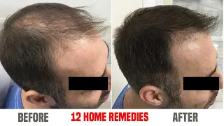 12 Proven Remedies To Prevent Hair Loss And Regrow Your Hair