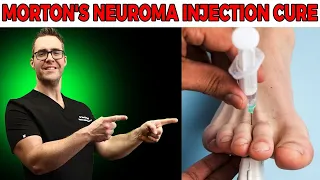 Morton's Neuroma Injection Cure 2021 [Neuroma Cortisone Injection]