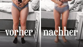 Lipödem OP: Vorher und Nachher in 7 Fragen