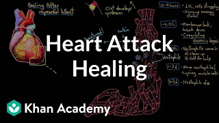 Healing after a heart attack (myocardial infarction) | NCLEX-RN | Khan Academy